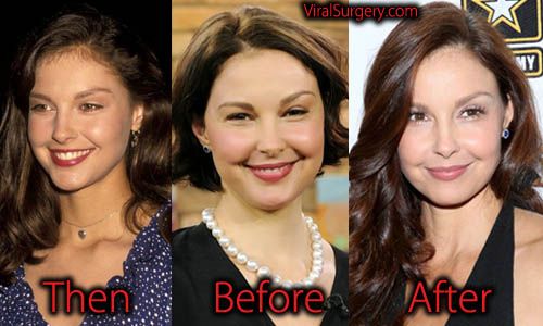Ashley Judd face accident and plastic surgery