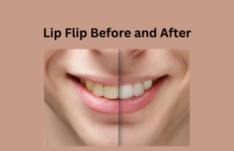 Lip flip: What it is, side effects, results, and more - Tech Preview